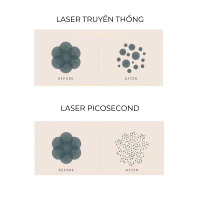 cong-nghe-picosecond-laser (3)