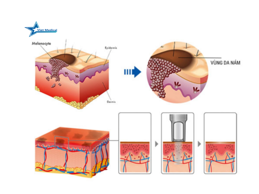 cong-nghe-Laser-NdYag- -Switched-la-gi (2)