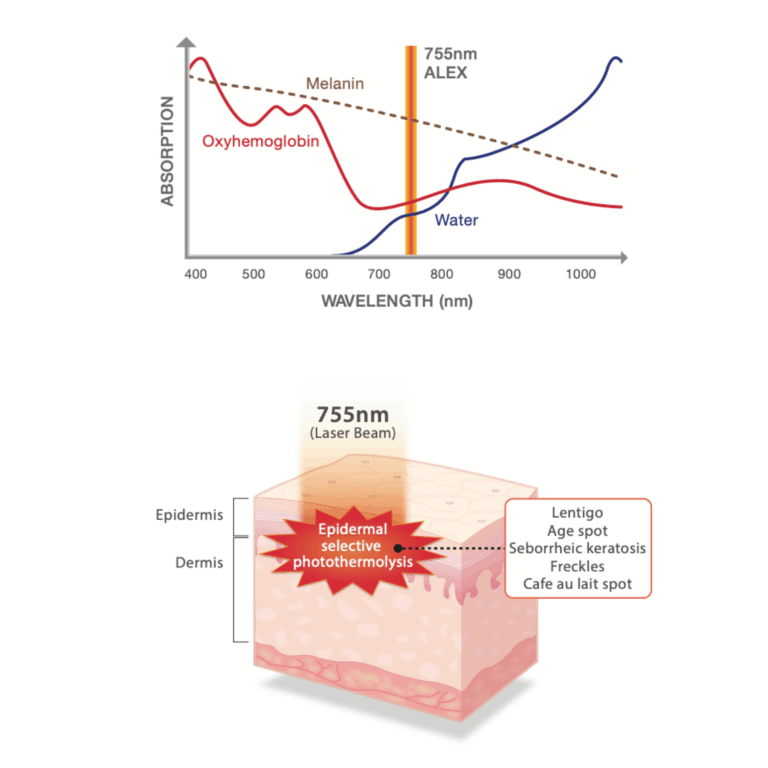 dual-accento-laser (2)